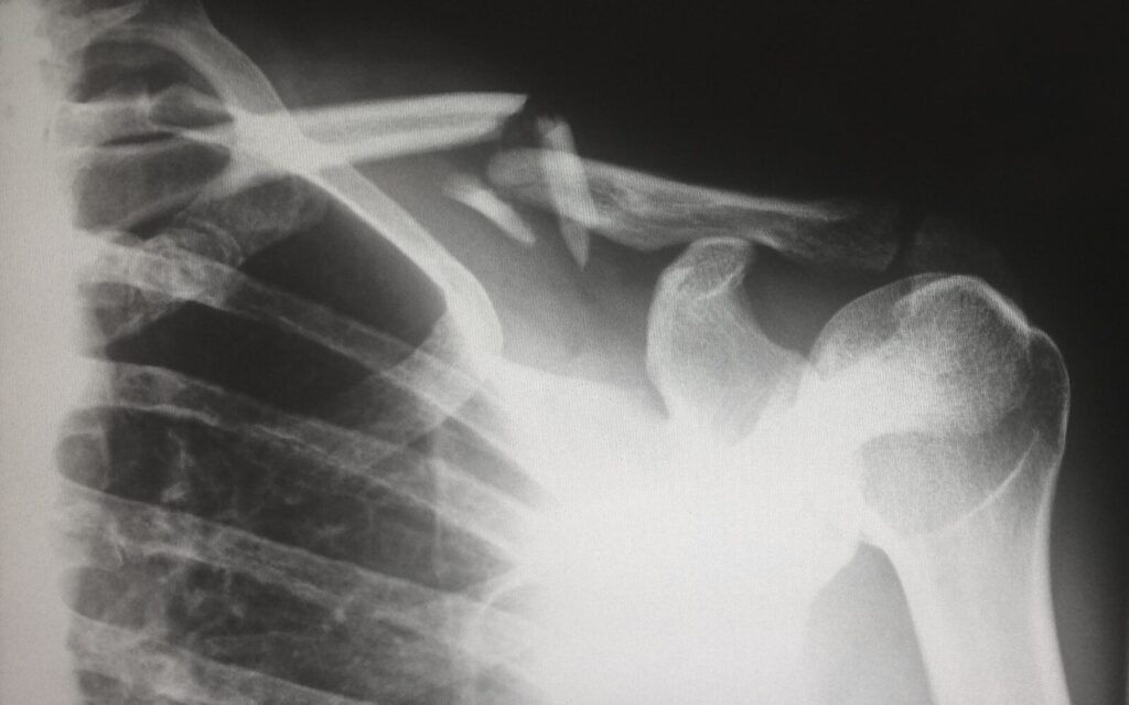 errores en la recuperación muscular
